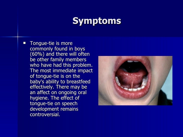 Laser Release Tongue Tie