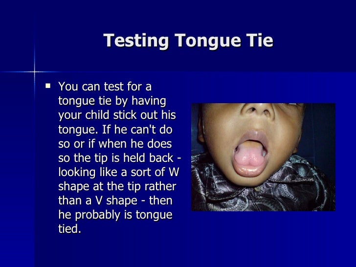 What does it mean if you are tongue-tied?