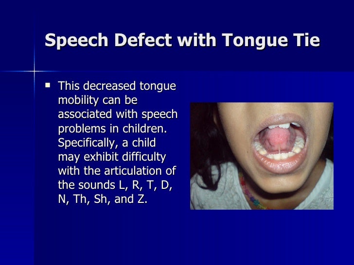 Laser Release Tongue Tie