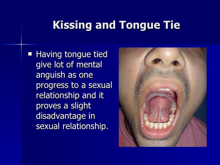 What Does The Song Tongue Tied Mean Laser Release Tongue Tie