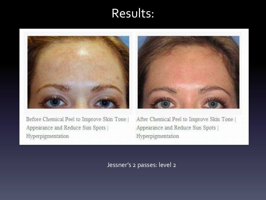 Laser Resurfacing, Dermabrasion, Chemical Peel In The Asian Ethnic Cl…