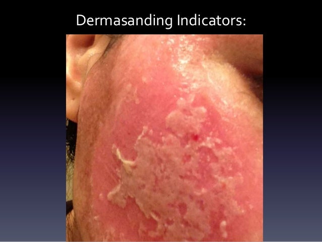 chemical work how indicators Peel Resurfacing, In Laser The Chemical Dermabrasion,