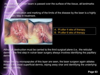 As soon as the laser beam is passed over the surface of the tissue, all landmarks 
disappear. 
Proper identification and marking of the limits of the disease by the laser is a highly 
necessary step in treatment. 
Although destruction must be carried to the third surgical plane (i.e., the reticular 
dermis), the first step in vulvar laser surgery always involves identifying the papillary 
dermis. 
When the tiny micropapules of this layer are seen, the laser surgeon again ablates 
through this most superficial dermis, wiping away char and identifying the underlying 
reticular dermis. 
Page 63 
A. Pt after 4 wks of therapy. 
B. Pt after 6 wks of therapy 
 