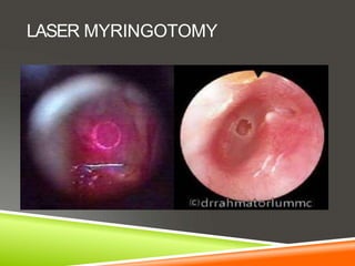 LASER MYRINGOTOMY
 