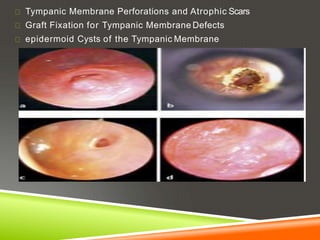 Tympanic Membrane Perforations and Atrophic Scars
Graft Fixation for Tympanic Membrane Defects
epidermoid Cysts of the Tympanic Membrane
 