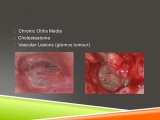 Chronic Otitis Media
Cholesteatoma
Vascular Lesions (glomus tumour)
 