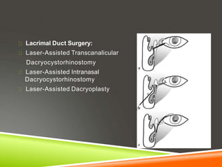 Lacrimal Duct Surgery:
Laser-Assisted Transcanalicular
Dacryocystorhinostomy
Laser-Assisted Intranasal
Dacryocystorhinostomy
Laser-Assisted Dacryoplasty
 