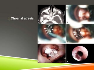 Choanal atresia
 