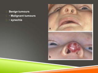 Benign tumours
Malignant tumours
synechia
 