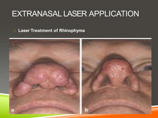 EXTRANASAL LASER APPLICATION
Laser Treatment of Rhinophyma
 