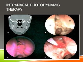 INTRANASAL PHOTODYNAMIC
THERAPY
 