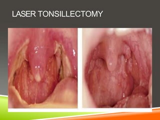 LASER TONSILLECTOMY
 