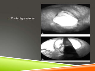 Contact granuloma
 