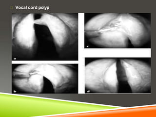 Vocal cord polyp
 