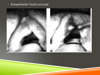 Subepithelial Vocal cord cyst
 
