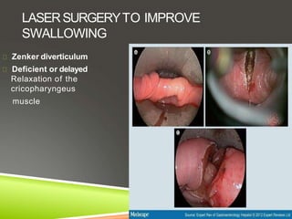 LASERSURGERYTO IMPROVE
SWALLOWING
Zenker diverticulum
Deficient or delayed
Relaxation of the
cricopharyngeus
muscle
 