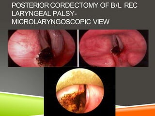 POSTERIOR CORDECTOMY OF B/L REC
LARYNGEAL PALSY-
MICROLARYNGOSCOPIC VIEW
 