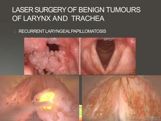 LASERSURGERYOF BENIGN TUMOURS
OF LARYNX AND TRACHEA
RECURRENTLARYNGEALPAPILLOMATOSIS
 
