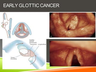 EARLY GLOTTIC CANCER
 