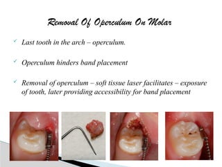 Lasers in orthodontics Diagnosisand management.pptx