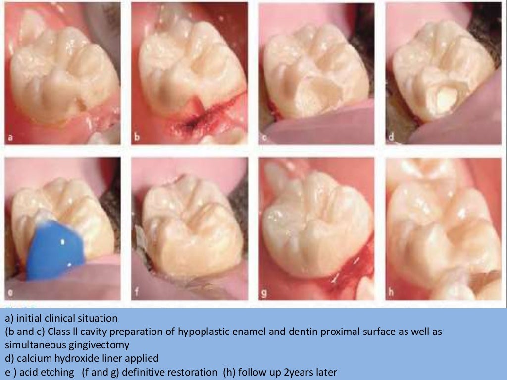 Lasers in pediatric dentistry