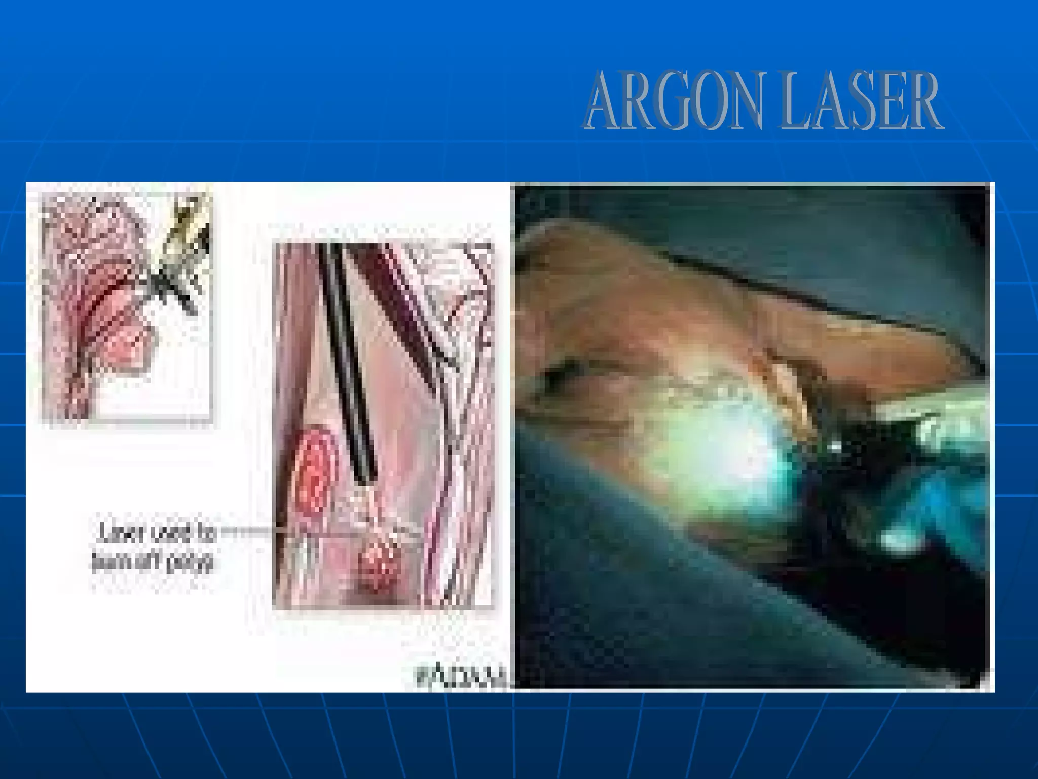 ARGON LASER 