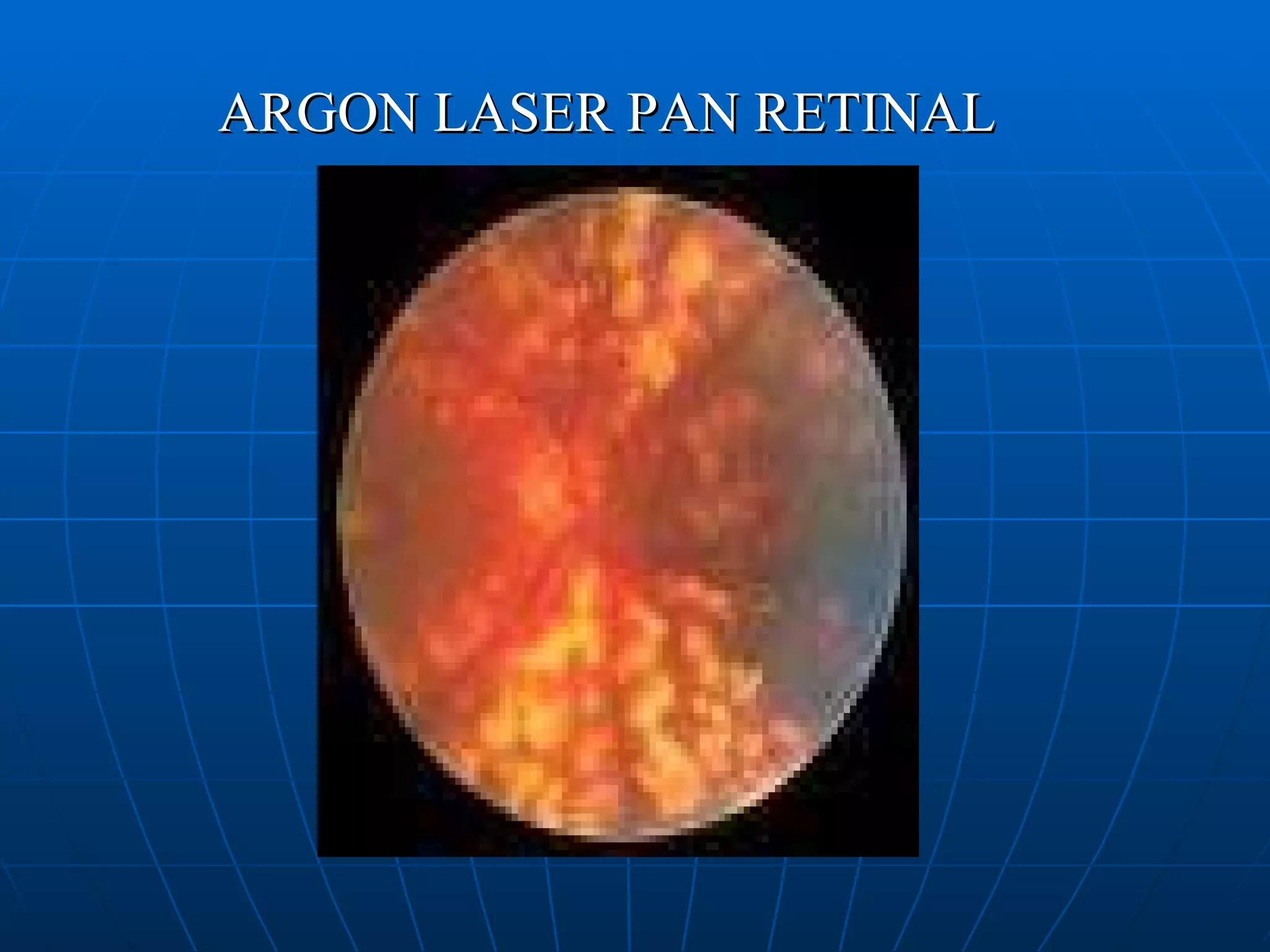 ARGON LASER PAN RETINAL 