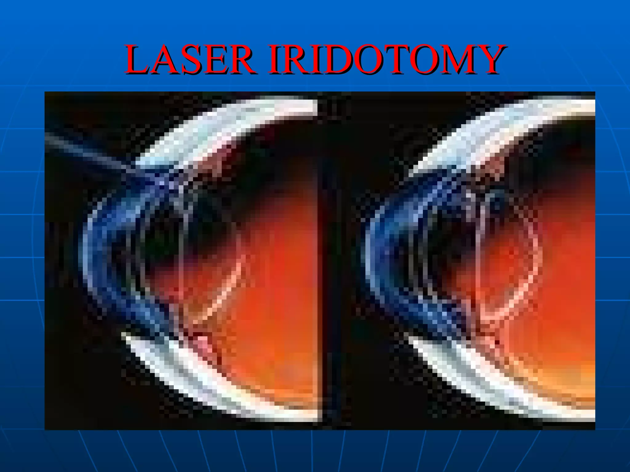 LASER IRIDOTOMY 