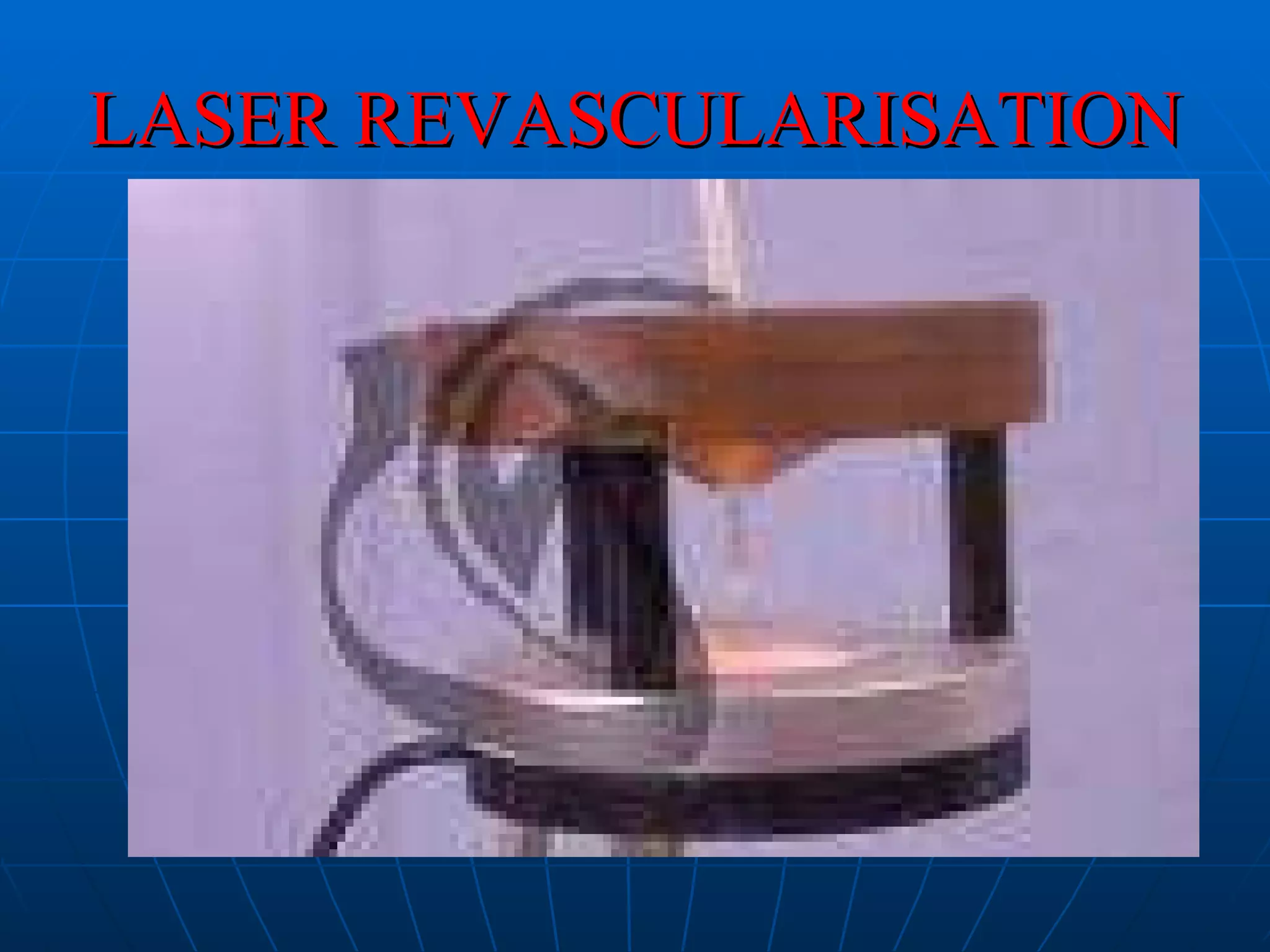LASER REVASCULARISATION 