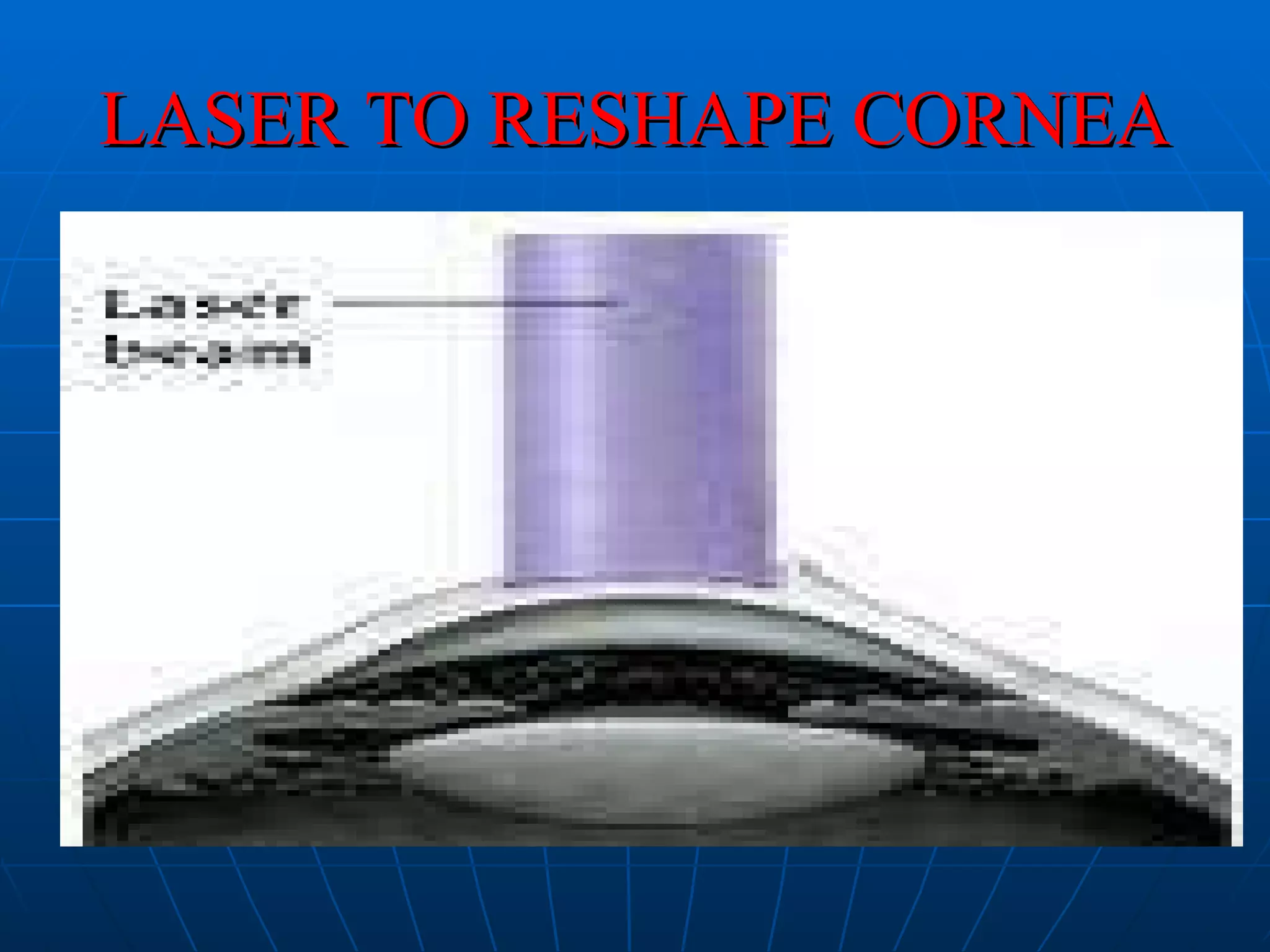 LASER TO RESHAPE CORNEA 