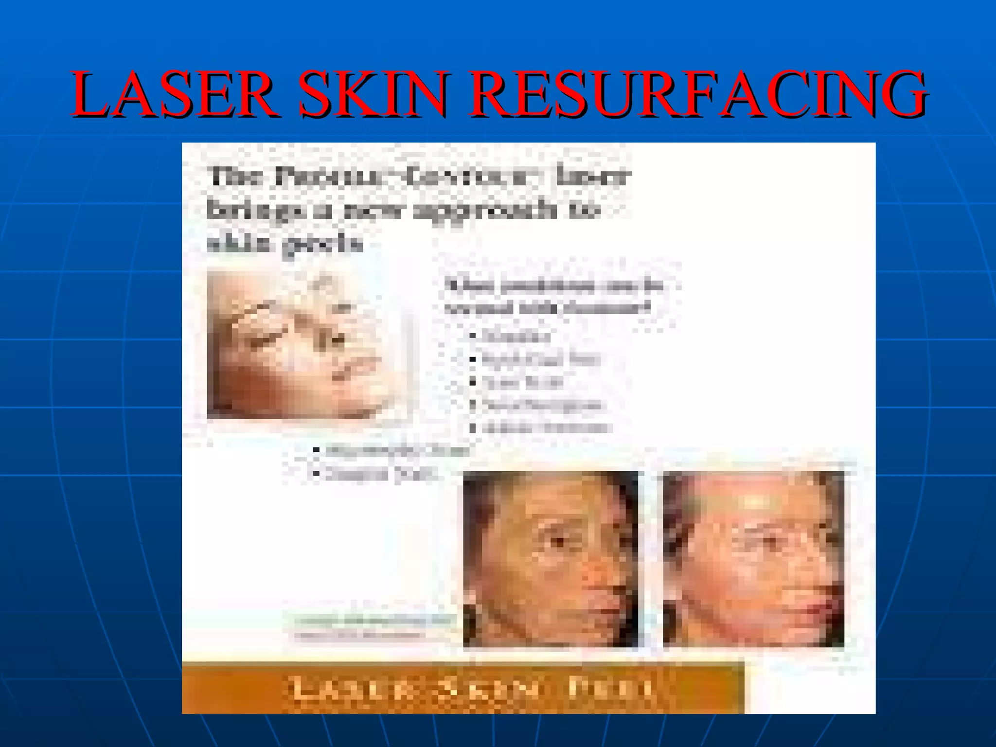 LASER SKIN RESURFACING 