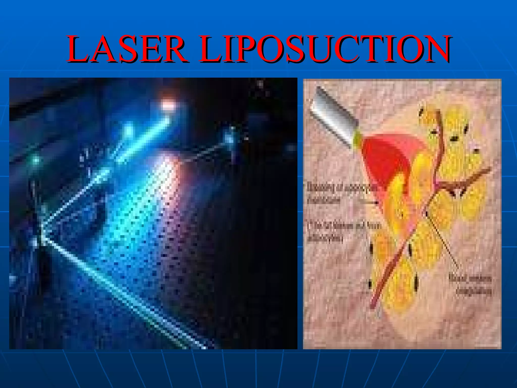 LASER LIPOSUCTION 