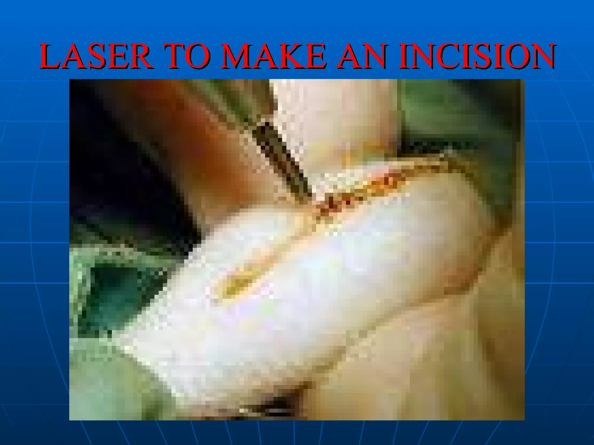 LASER TO MAKE AN INCISION 