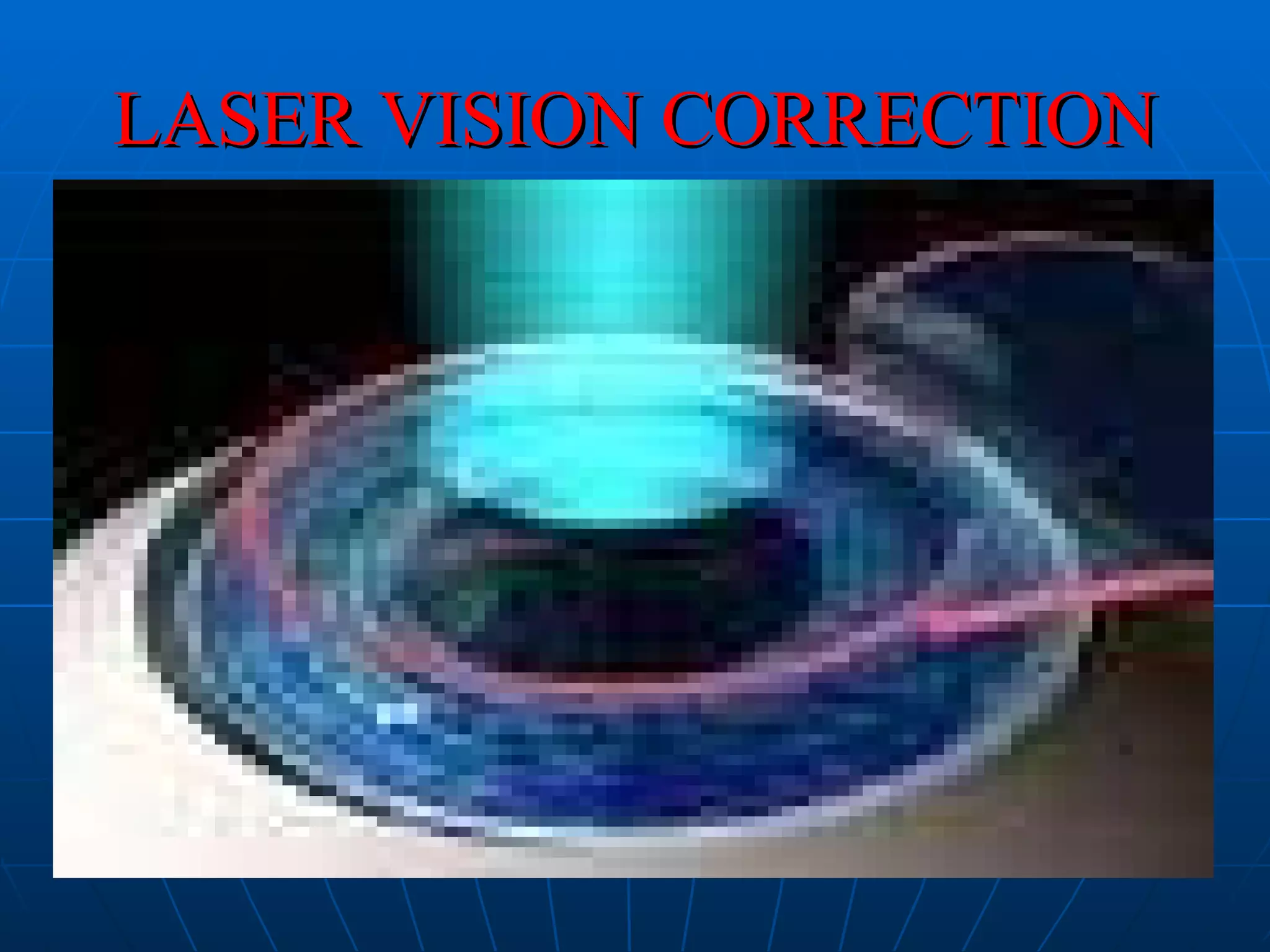 LASER VISION CORRECTION 