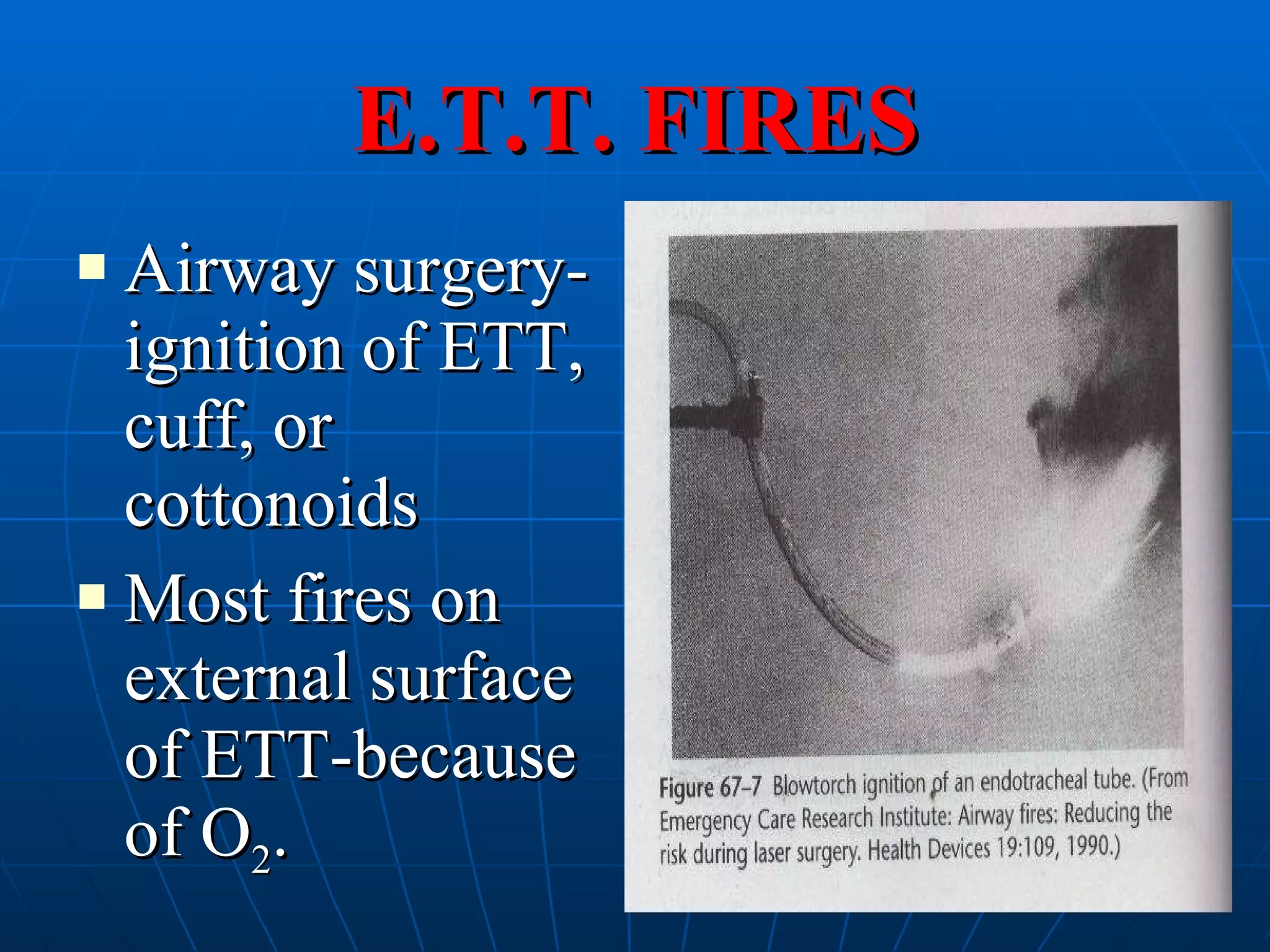 E.T.T. FIRES Airway surgery-ignition of ETT, cuff, or cottonoids Most fires on external surface of ETT-because of O 2 .  