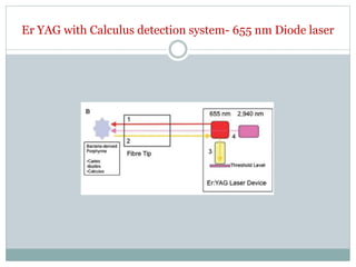 Er YAG with Calculus detection system- 655 nm Diode laser
 