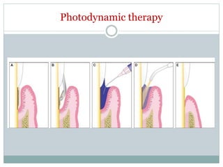 Photodynamic therapy
 