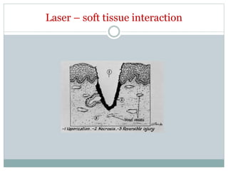 Laser – soft tissue interaction
 
