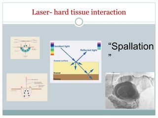 Laser- hard tissue interaction
“Spallation
”
 