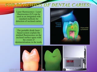 Laser fluorescence:- Laser
fluorescence (LF) can be
used as an integrated with
standard methods for
detection of occlusal caries.
The portable diode laser-
based system explain the
emitted fluorescence on the
occlusal surface agree with
the extent of
demineralization in the tooth.
LASERS AND ITS APPLICATION IN CONSERVATIVE AND ENDODONTIC
DENTISTRY
40
 