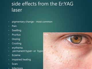 side effects from the Er:YAG
laser
• pigmentary change - most common
• Pain
• Swelling
• Pruritus
• Oozing
• Crusting
• erythema.
• permanent hyper- or hypopigmentation
• Eczema
• impaired healing
• Scars
Milia
 