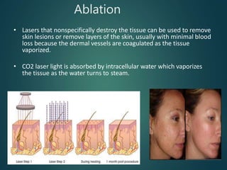 Ablation
• Lasers that nonspecifically destroy the tissue can be used to remove
skin lesions or remove layers of the skin, usually with minimal blood
loss because the dermal vessels are coagulated as the tissue
vaporized.
• CO2 laser light is absorbed by intracellular water which vaporizes
the tissue as the water turns to steam.
 