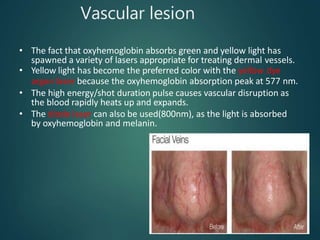 Vascular lesion
• The fact that oxyhemoglobin absorbs green and yellow light has
spawned a variety of lasers appropriate for treating dermal vessels.
• Yellow light has become the preferred color with the yellow dye
argon laser because the oxyhemoglobin absorption peak at 577 nm.
• The high energy/shot duration pulse causes vascular disruption as
the blood rapidly heats up and expands.
• The diode laser can also be used(800nm), as the light is absorbed
by oxyhemoglobin and melanin.
 