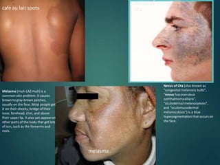 café au lait spots
melasma
nevus of
ota
Nevus of Ota (also known as
"congenital melanosis bulbi",
"nevus fuscoceruleus
ophthalmomaxillaris",
"oculodermal melanocytosis",
and "oculomucodermal
melanocytosis") is a blue
hyperpigmentation that occurs on
the face.
Melasma (muh-LAZ-muh) is a
common skin problem. It causes
brown to gray-brown patches,
usually on the face. Most peopleget
it on their cheeks, bridge of their
nose, forehead, chin, and above
their upper lip. It also can appearon
other parts of the body that get lots
of sun, such as the forearms and
neck.
 