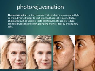 photorejuvenation
Photorejuvenation is a skin treatment that uses lasers, intense pulsed light,
or photodynamic therapy to treat skin conditions and remove effects of
photo aging such as wrinkles, spots, and textures. The process induces
controlled wounds on the skin, prompting it to heal itself by creating new
cells.
 