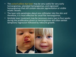 • The pulsed yellow dye laser may be very useful for very early
hemangiomas, ulcerated hemangiomas, and regressed
hemangiomas that still contain vascular pigmentation or visible
ectatic vessels.
• The laser only penetrates about one millimeter into the skin and
therefore, it is most effective for small flat hemangiomas.
• Multiple laser treatment may be necessary every two to four weeks
during the proliferative phase as hemangiomas will often exhibit
temporary regression followed by rebound growth.
 