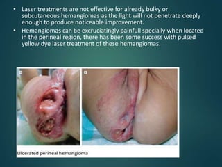 • Laser treatments are not effective for already bulky or
subcutaneous hemangiomas as the light will not penetrate deeply
enough to produce noticeable improvement.
• Hemangiomas can be excruciatingly painfull specially when located
in the perineal region, there has been some success with pulsed
yellow dye laser treatment of these hemangiomas.
 