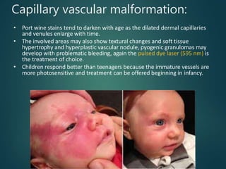 Capillary vascular malformation:
• Port wine stains tend to darken with age as the dilated dermal capillaries
and venules enlarge with time.
• The involved areas may also show textural changes and soft tissue
hypertrophy and hyperplastic vascular nodule, pyogenic granulomas may
develop with problematic bleeding, again the pulsed dye laser (595 nm) is
the treatment of choice.
• Children respond better than teenagers because the immature vessels are
more photosensitive and treatment can be offered beginning in infancy.
 