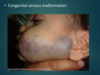 • Congenital venous malformation
 