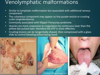 Venolymphatic malformations
• Similar to lymphatic malformation but associated with additional venous
component.
• The cutaneous component may appear as tiny purple vesicle or crusting
scabs (angiokeratoma).
• Commonly associated with Klippel-Trenaunay syndrome.
• Vesicles are more responsive to coagulation by continuous laser than the
yellow dye pulsed laser, therefore the KTP is more effective.
• Crusting lesions can be tangentially shaved, then compressed with a glass
slide to control bleeding before being lased.
Angiokeratoma
 